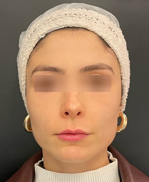 Caso 1, depois do tratamento, rosto de frente com os olhos desfocados