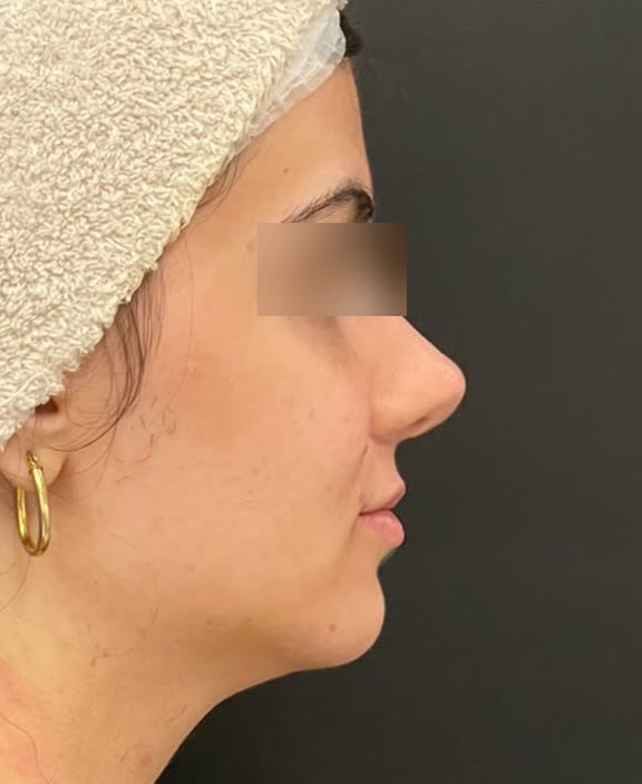 Caso 3, depois do tratamento, perfil do rosto com os olhos desfocados